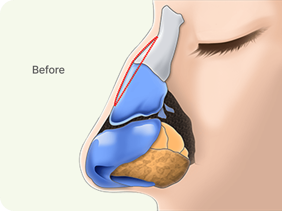 id Hospital - Rhinoplasty - Nose with a Large Hump Before