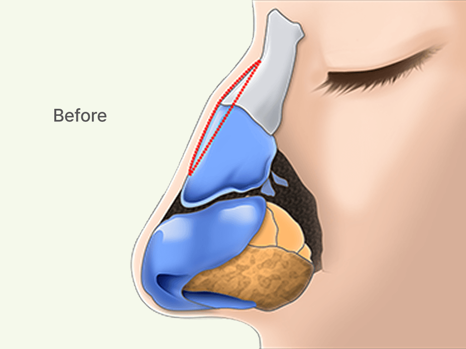 id Hospital - Rhinoplasty - Nose with a Hump and Crooked Bridge Before