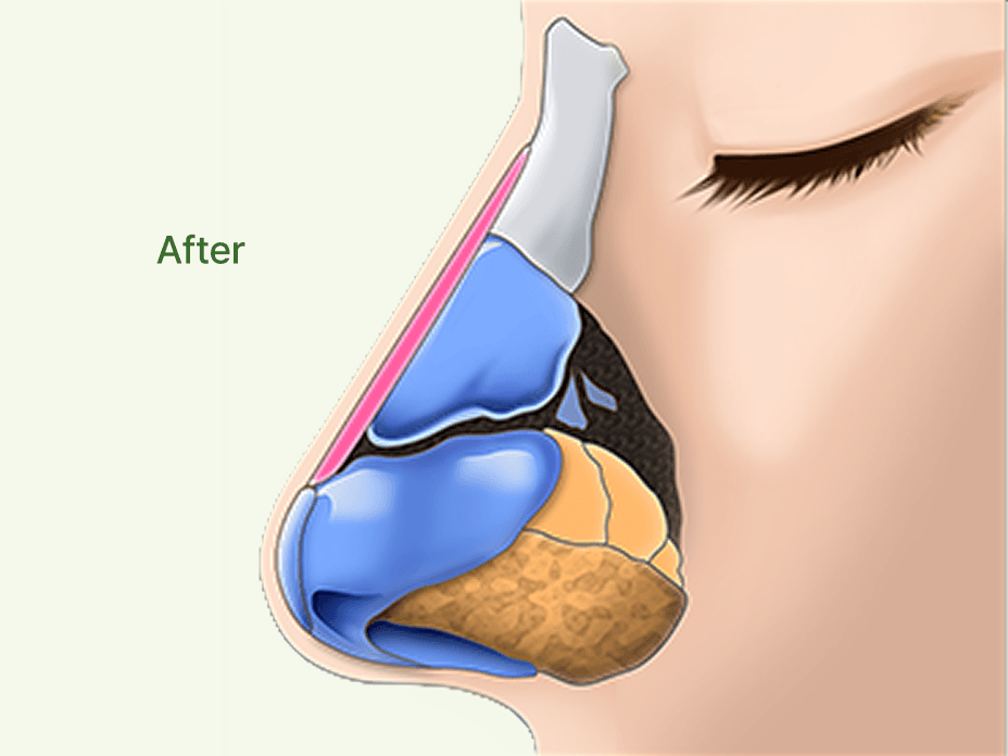 id Hospital - Rhinoplasty - Nose with a Hump and Crooked Bridge After