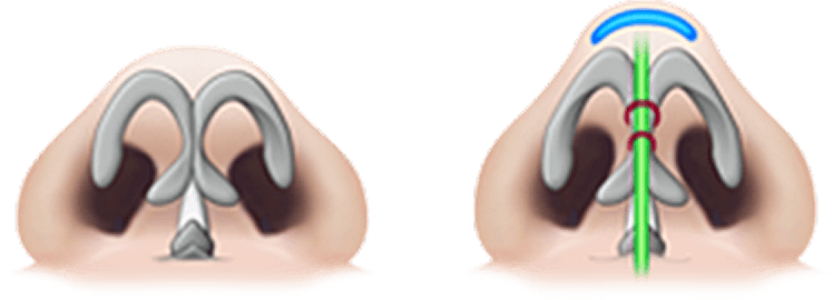 id Hospital - Rhinoplasty - Nasal Tip Not Collapsing
