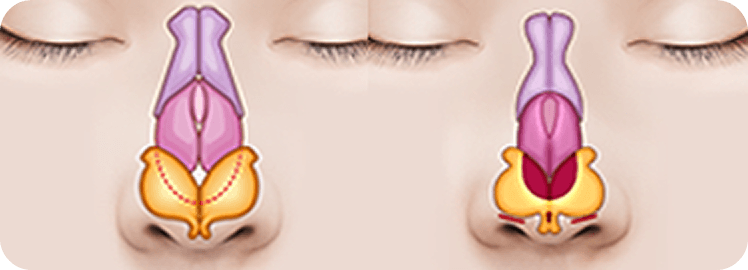 id Hospital - Rhinoplasty - Natural Nasal Tip Shape