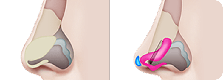id Hospital - Rhinoplasty - Sharper Nasal Tip
