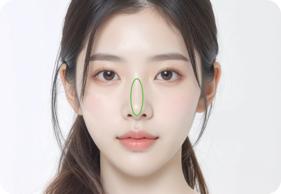 id Hospital - Nose Revision - When the implant is visible