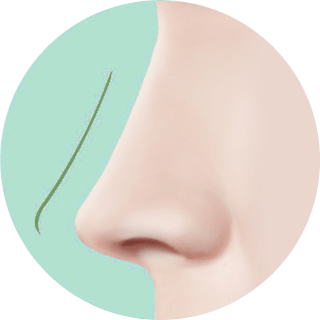 id Hospital - Nose Revision - Rib Cartilage Revision Step 1