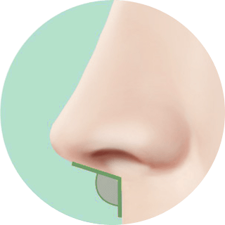 id Hospital - Nose Revision - Rib Cartilage Revision Step 2