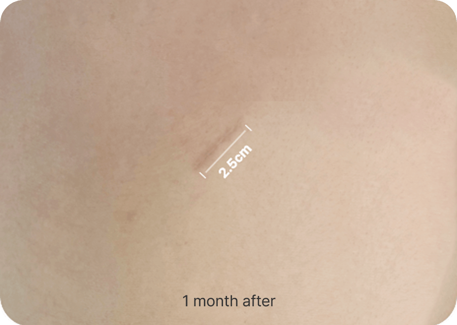 id Hospital - Nose Revision - Rib Cartilage Incision After 1 Month