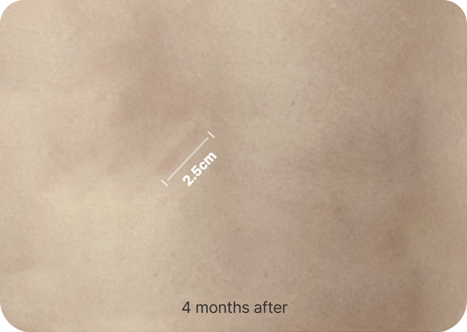 id Hospital - Nose Revision - Rib Cartilage Incision After 4 Months
