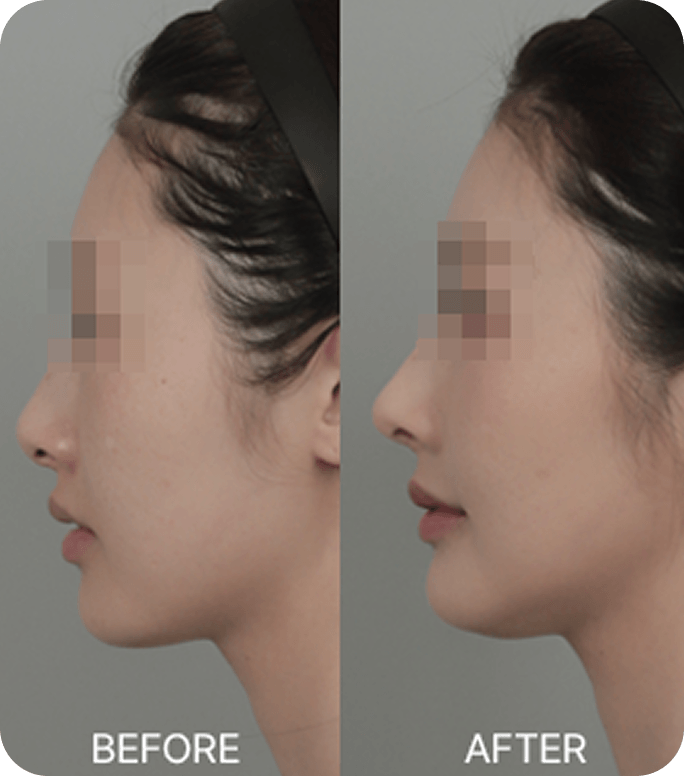 id Hospital - Nose Revision - Low and drooping nasal bridge and tip