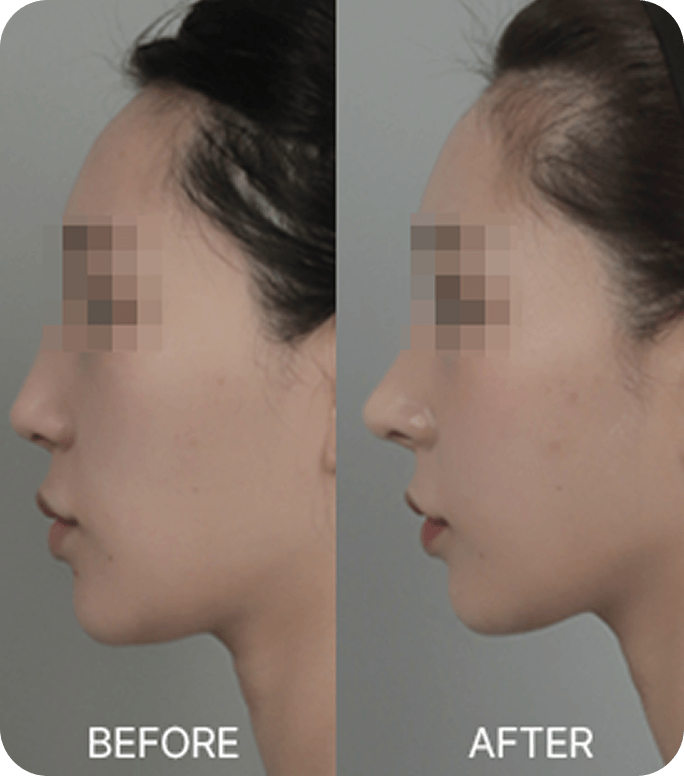 id Hospital - Nose Revision - Sunken-looking nasal bridge