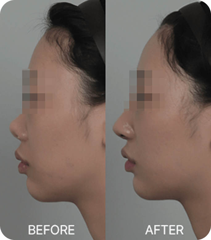 id Hospital - Nose Revision - Upturned nose due to contracture
