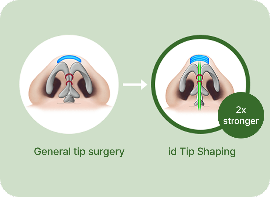 id Hospital - Nose Revision - Glamorous Nose Tip Shaping