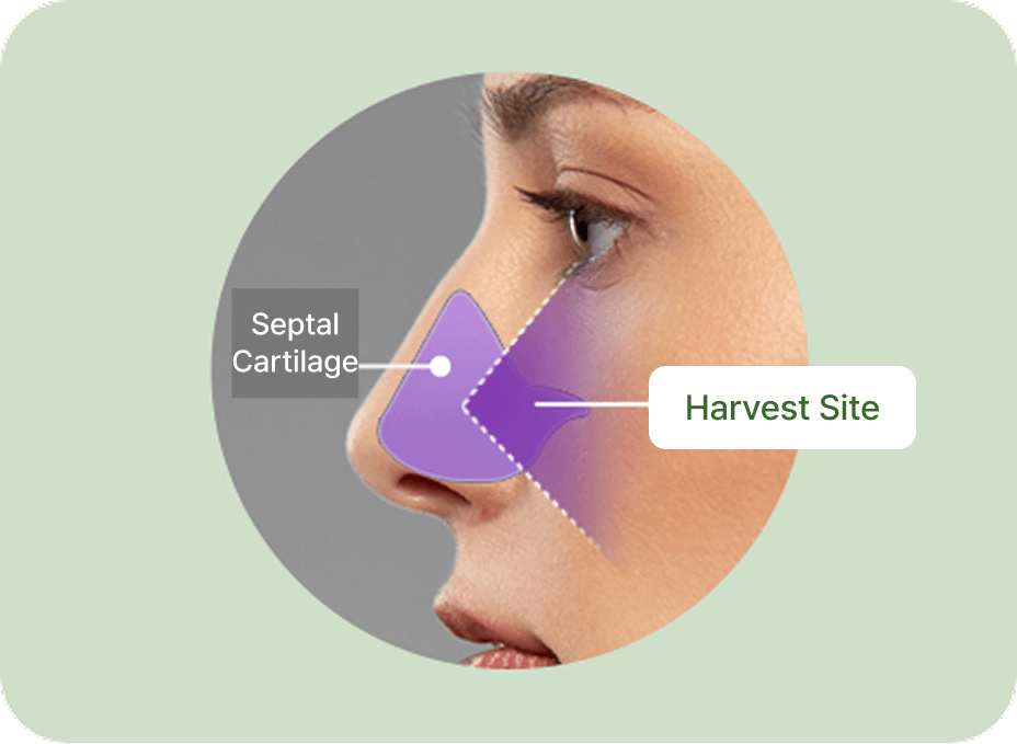 id Hospital - Nose Revision - Septal Cartilage