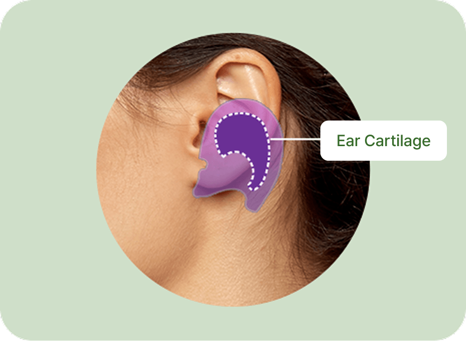id Hospital - Nose Revision - Ear Cartilage