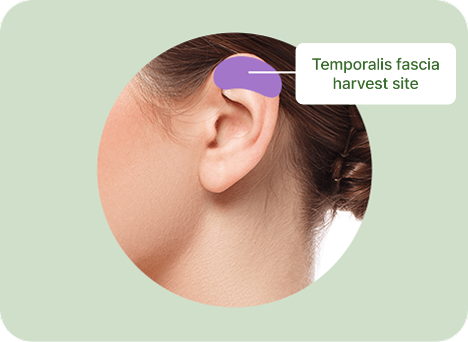 id Hospital - Nose Revision - Temporalis Fascia