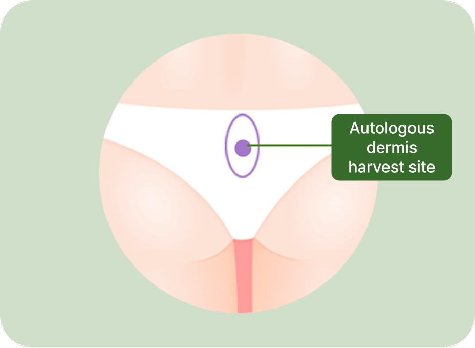 id Hospital - Nose Revision - Autologous Dermis/Fat