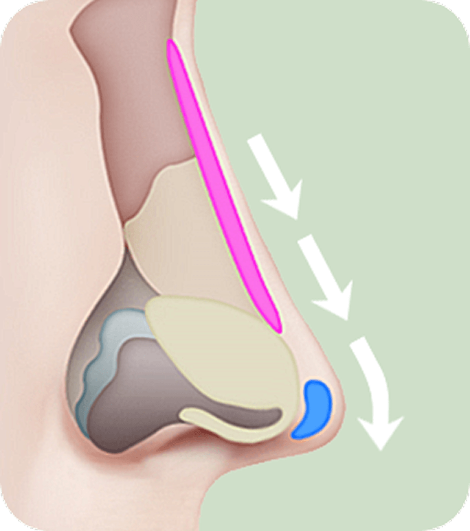 id Hospital - Nose Revision - General rhinoplasty