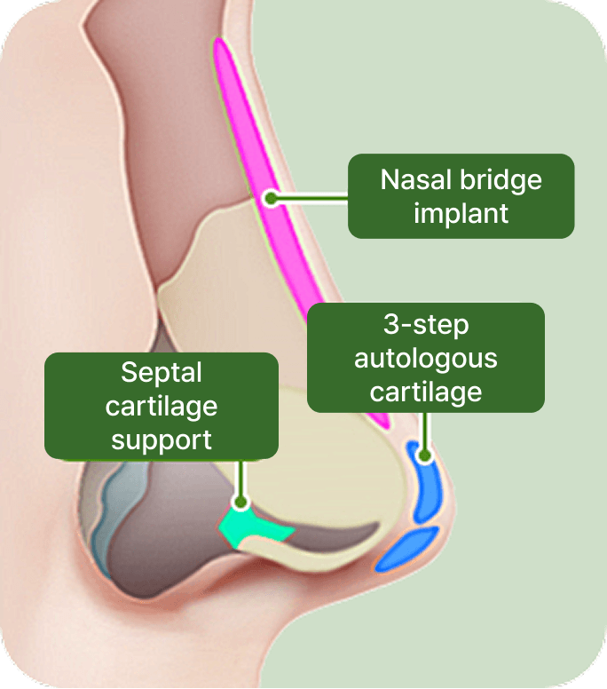 id Hospital - Nose Revision - id 3-step serial extension