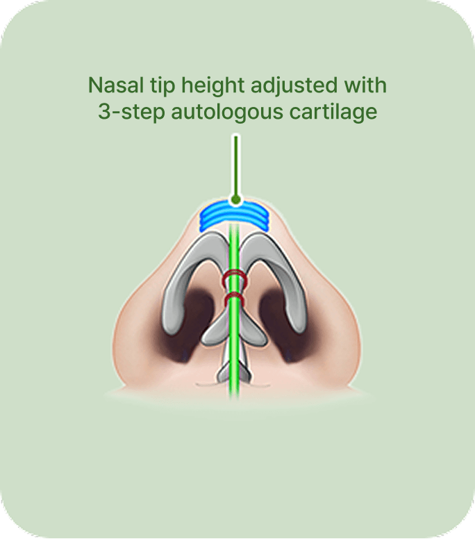 id Hospital - Nose Revision - 3-step autologous cartilage