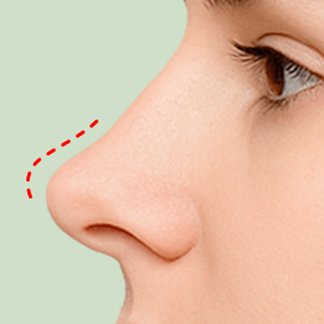 id Hospital - Partial Nose Revision - Type 1