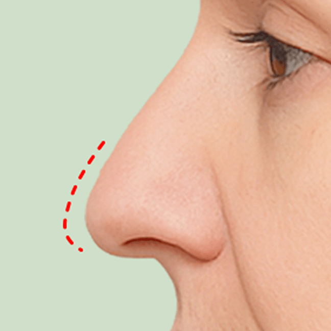 id Hospital - Partial Nose Revision - Type 2