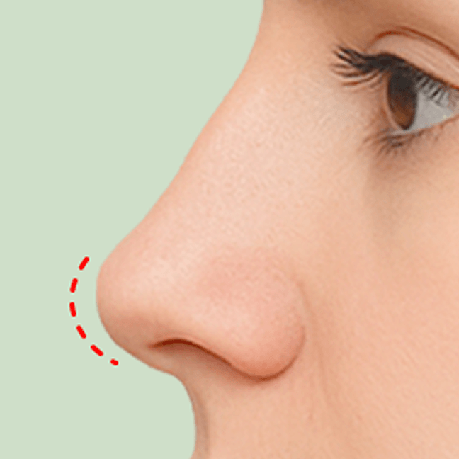 id Hospital - Partial Nose Revision - Type 3
