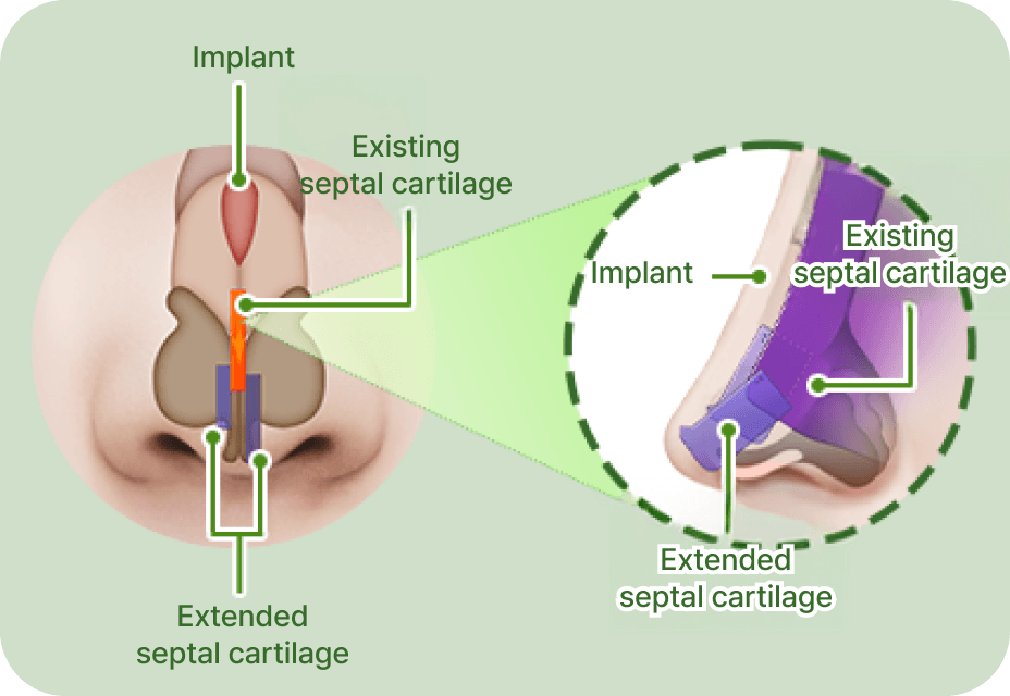 id Hospital - Nose Revision - Tip Angle Fixation Result