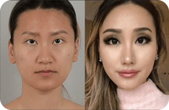 id Hospital - Asian Rhinoplasty - Before & After 1