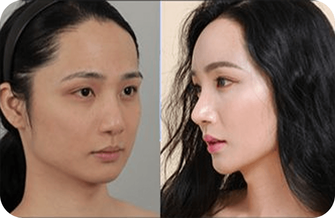 id Hospital - Asian Rhinoplasty - Before & After 2