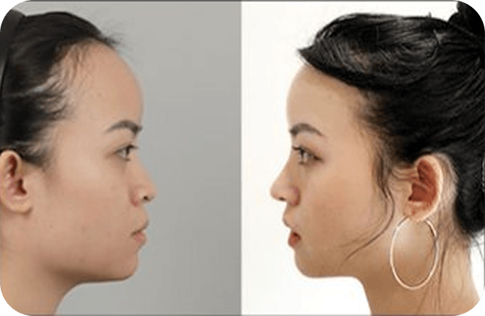 id Hospital - Asian Rhinoplasty - Before & After 3