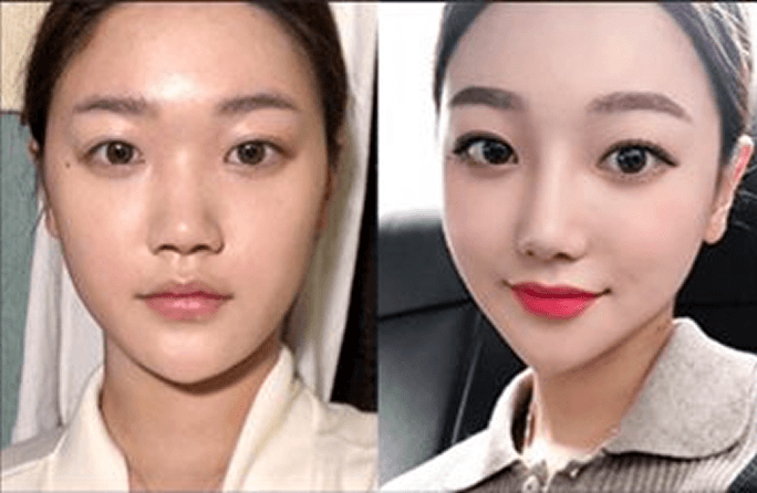 id Hospital - Asian Rhinoplasty - Before & After 4