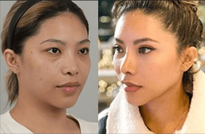 id Hospital - Asian Rhinoplasty - Before & After 5