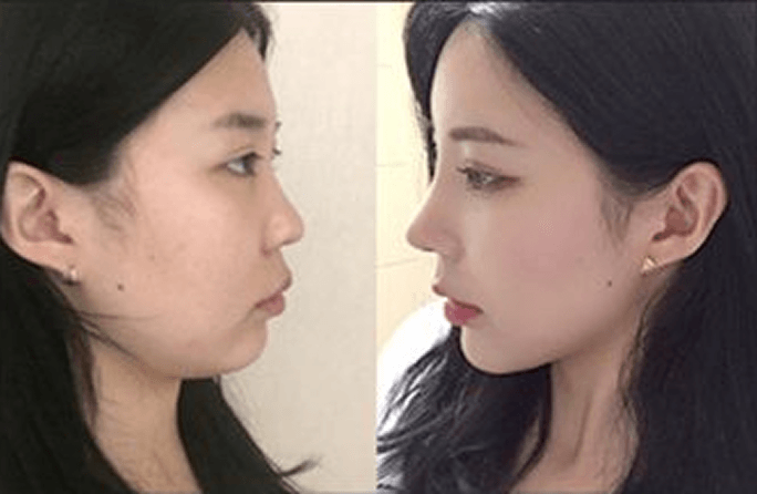 id Hospital - Asian Rhinoplasty - Before & After 6