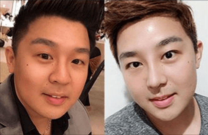 id Hospital - Asian Rhinoplasty - Before & After 7