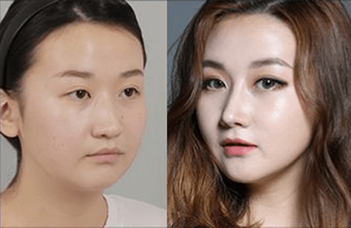 id Hospital - Asian Rhinoplasty - Before & After 8