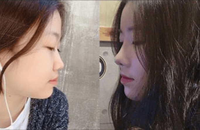 id Hospital - Asian Rhinoplasty - Before & After 9