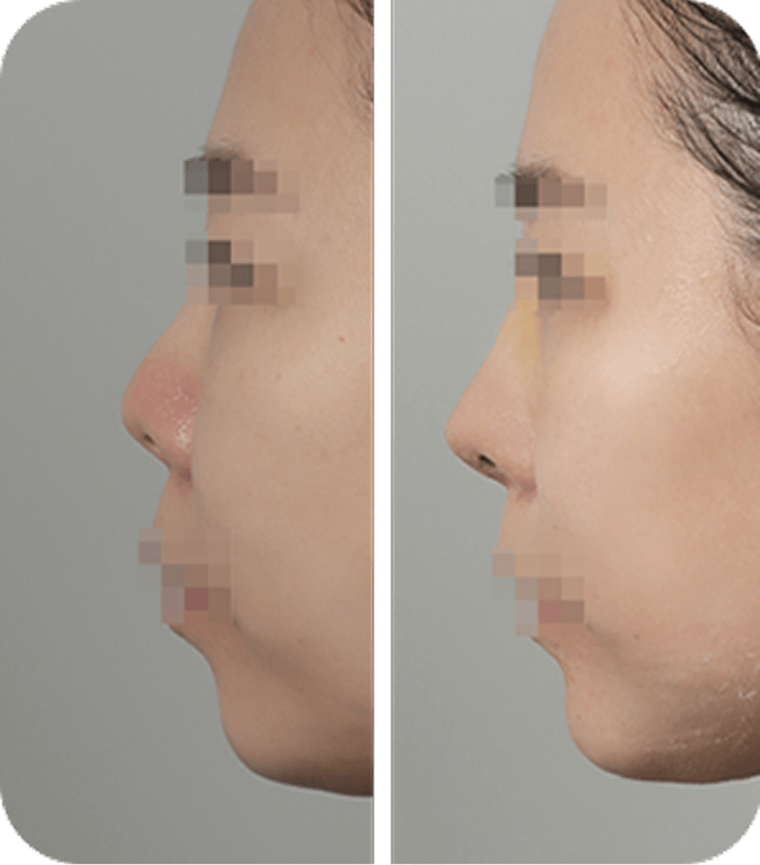 Before & After image