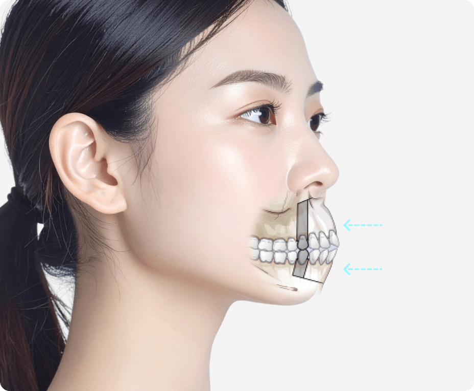 id Hospital - Mouth Protrusion Surgery - Bone Repositioning