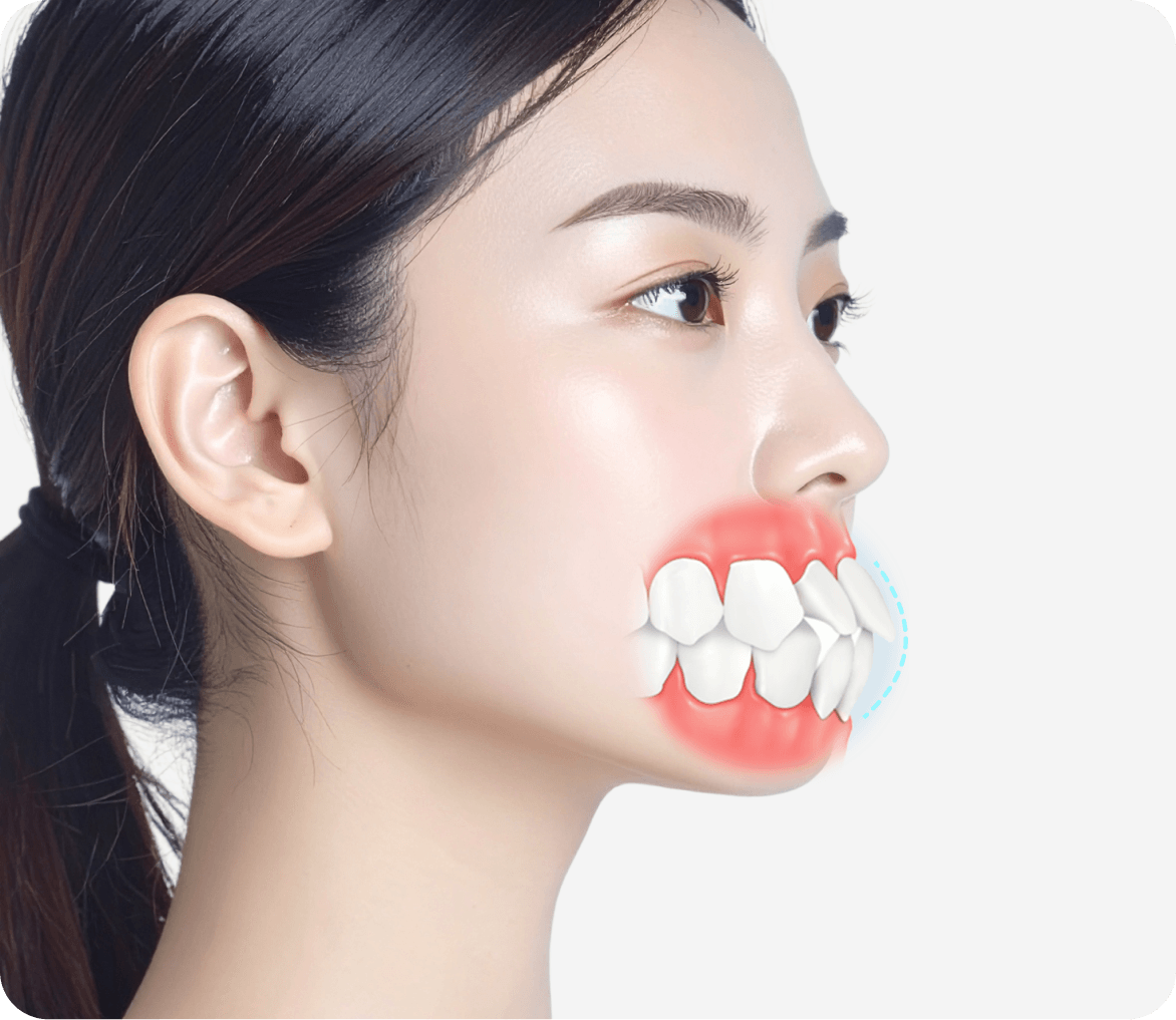 id Hospital - Mouth Protrusion Surgery - Teeth Protrusion Candidates
