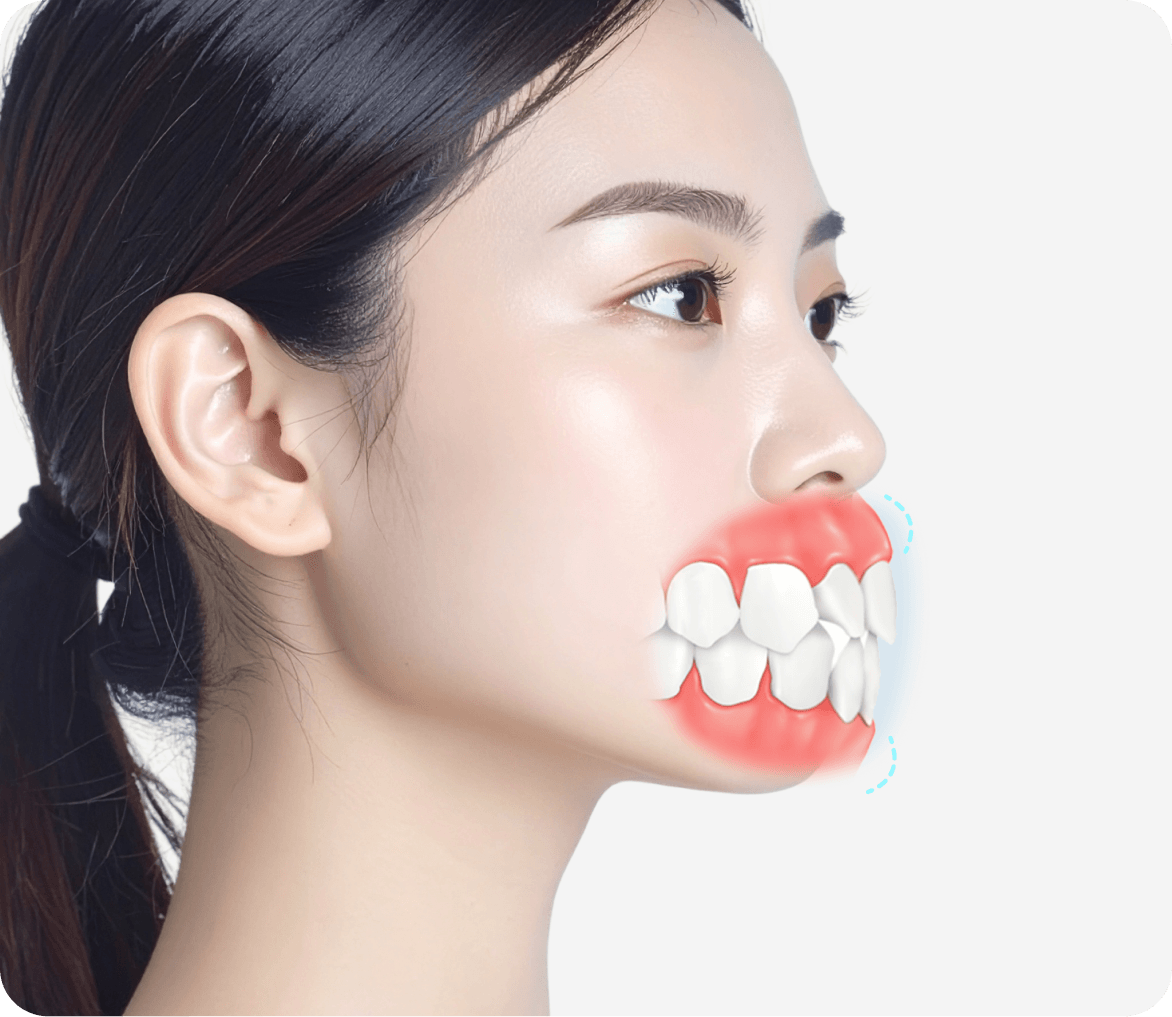id Hospital - Mouth Protrusion Surgery - Gum Protrusion Candidates