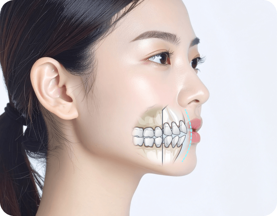 id Hospital - Mouth Protrusion Surgery - Correction with Bimaxillary Protrusion Surgery