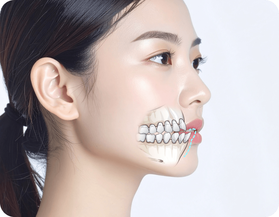 id Hospital - Mouth Protrusion Surgery - Correction with Two-Jaw Surgery