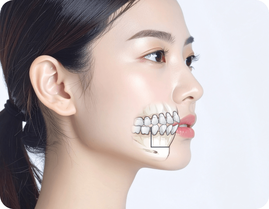id Hospital - Mouth Protrusion Surgery - Correction with Three-Jaw Surgery