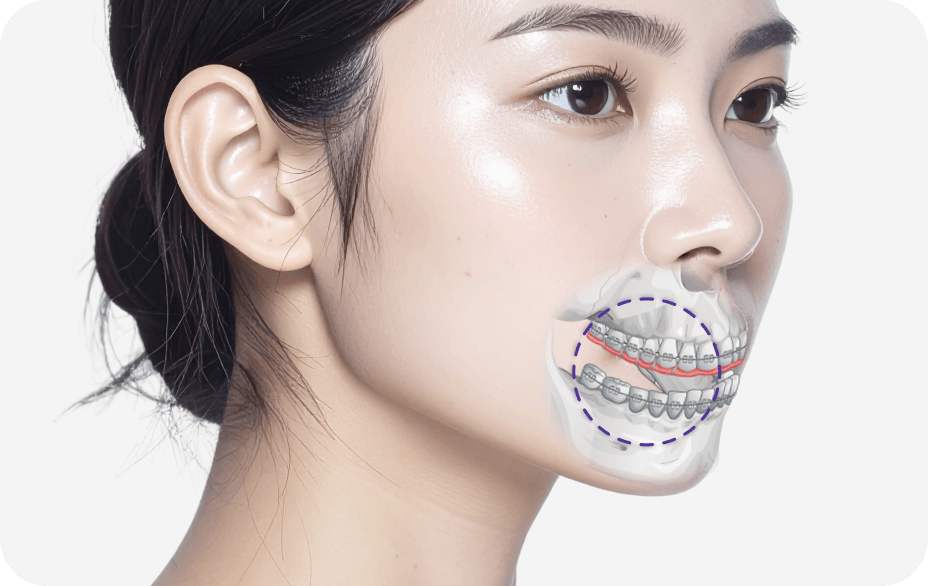 id Hospital - No-tie Orthognathic Surgery - id No-tie Double Jaw Surgery without Jaw Fixation