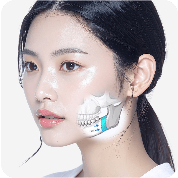 id Hospital - No-tie Orthognathic Surgery - Mandibular Resection and Repositioning