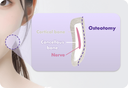 id Hospital - No-tie Orthognathic Surgery - Nerve Pathway Simulation