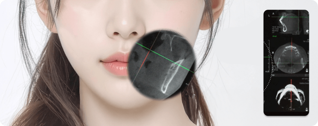id Hospital - No-tie Orthognathic Surgery - Precise Nerve Line Check