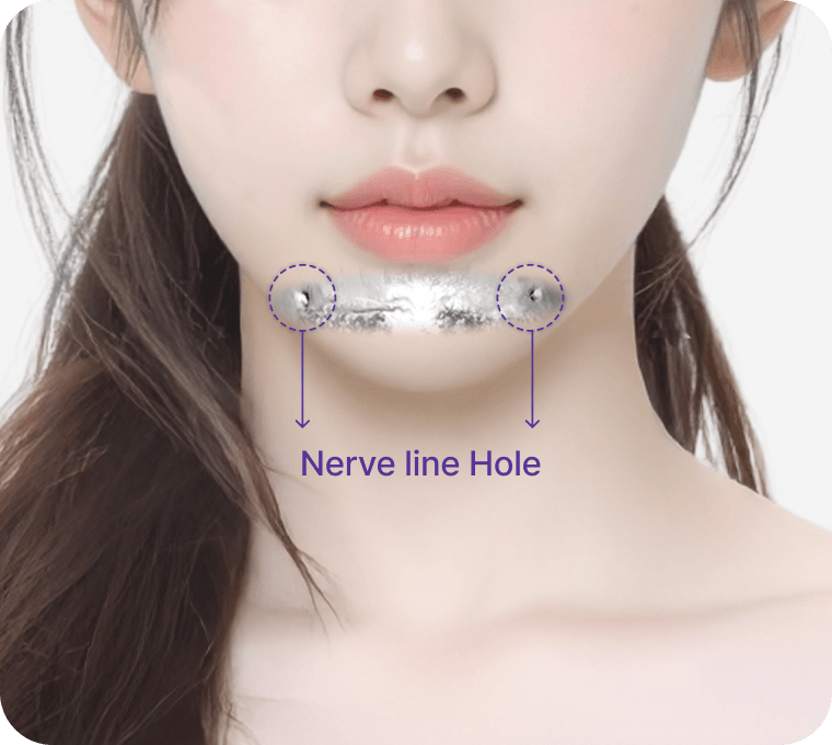 id Hospital - Orthognathic Surgery Revision - Safety with 3D-CT and Navigation System