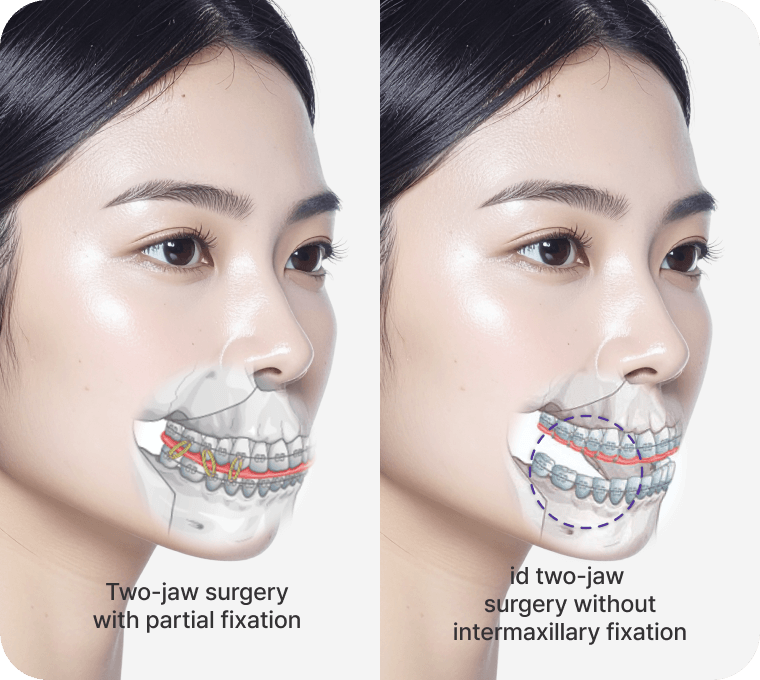 id Hospital - Orthognathic Surgery Revision - Precise Occlusion without Intermaxillary Fixation