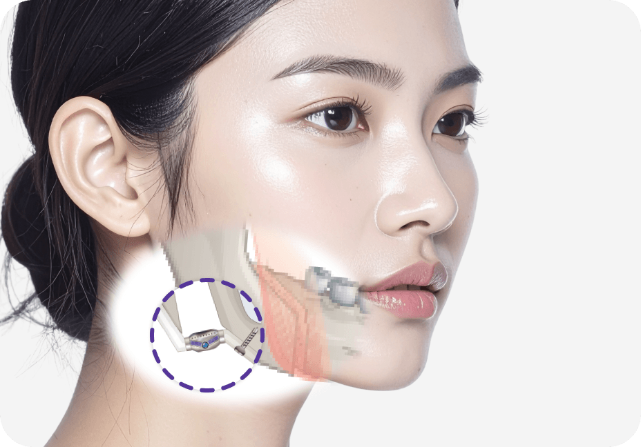id Hospital - Orthognathic Surgery Revision - Surgical Method Step 2