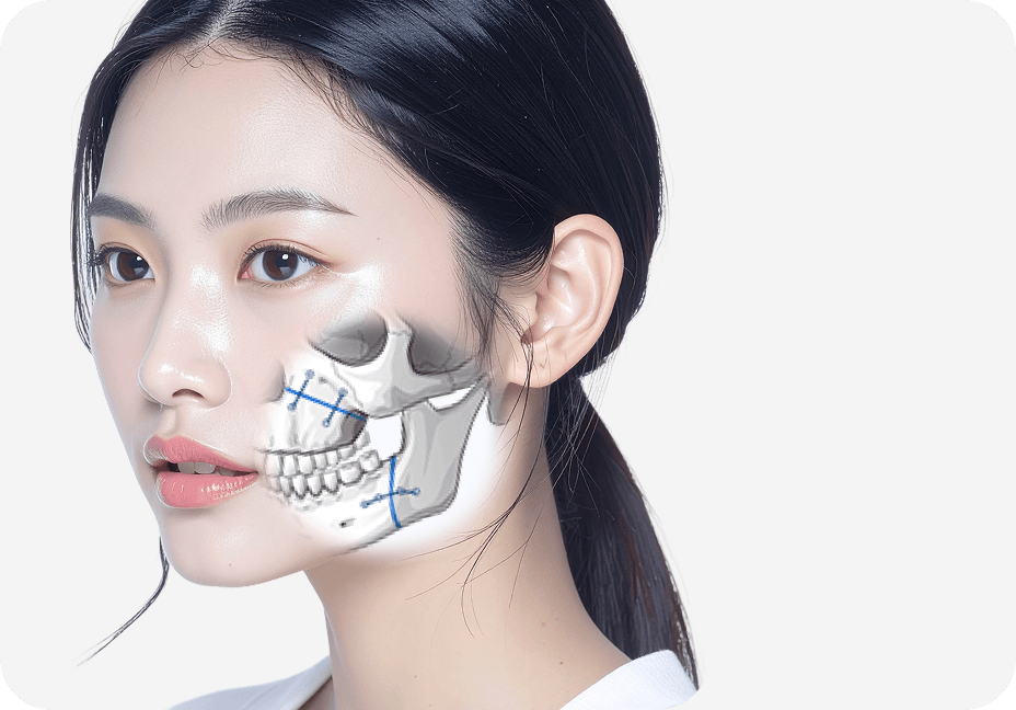 id Hospital - Orthognathic Surgery Revision - Surgical Method Step 3